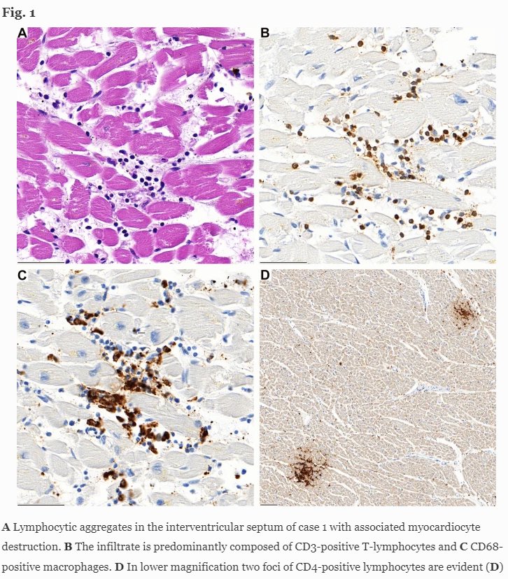 Lymphocyte immune cells (white blood cells) are shown in blue and brown among the heart tissue, causing localised inflammation that proved fatal 